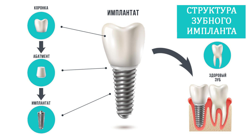 Имплант зуба. Из чего состоит зубной имплант