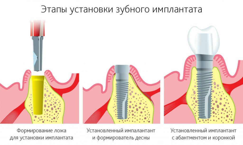 Этапы имплантации зубов